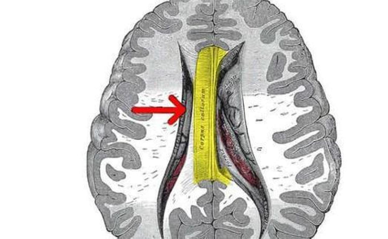 Encuentran las áreas cerebrales implicadas en las alucinaciones auditivas de los pacientes con esquizofrenia