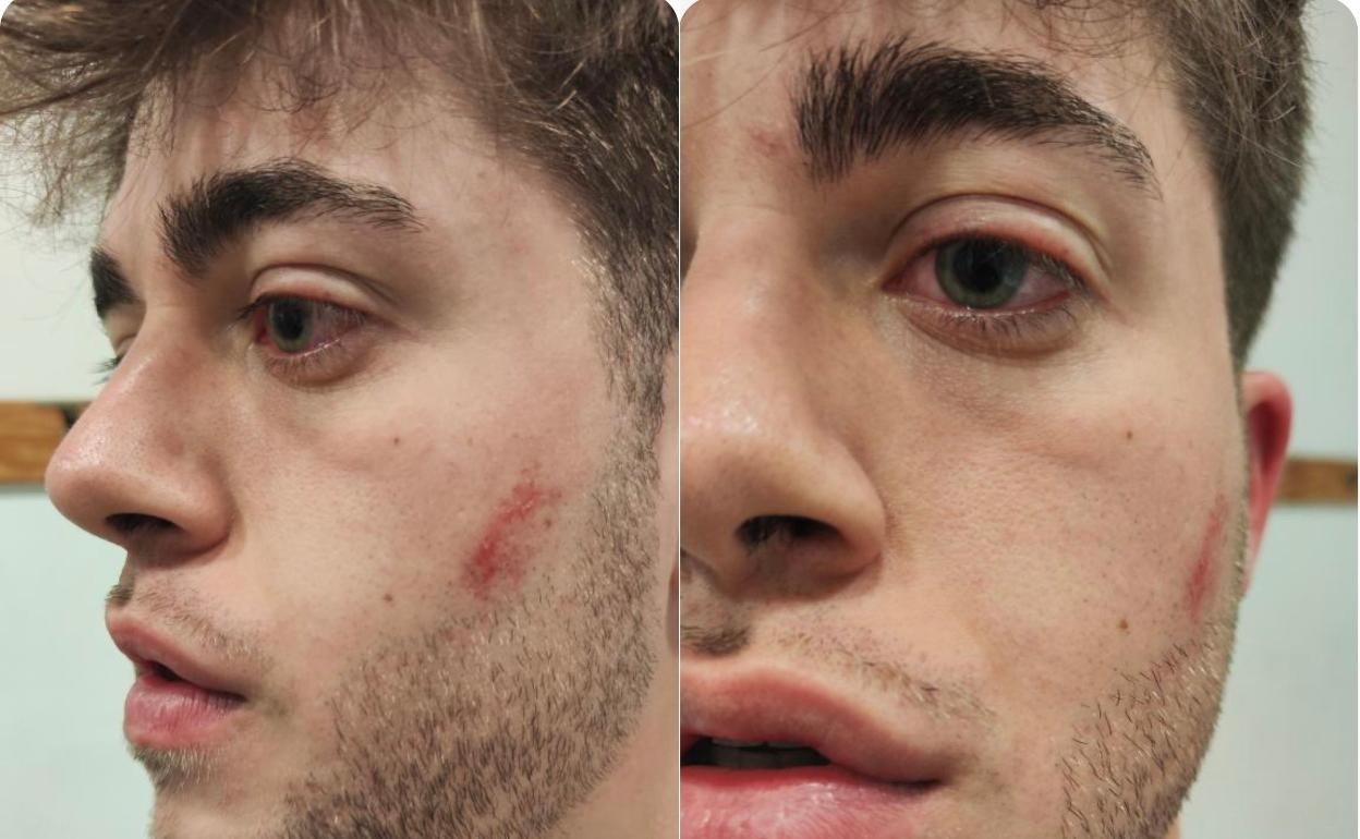 El árbitro, con las marca visibles tras la agresión. 