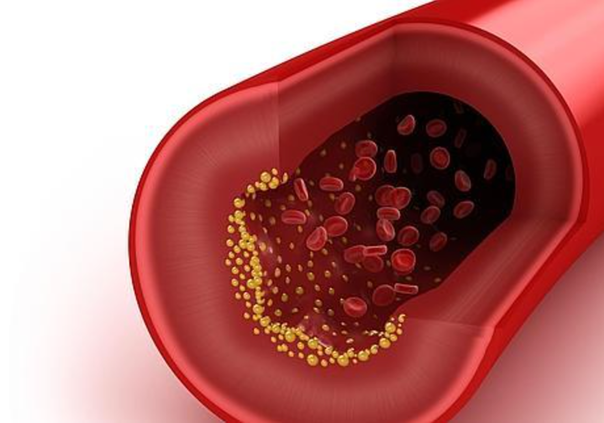 Hipercolesterolemia familiar, la enfermedad que afecta a más de 200.000 españoles