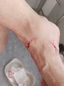 Herida causada por la tintorera.