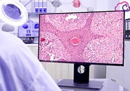 Tratamiento de un tumor con inteligencia artificial.