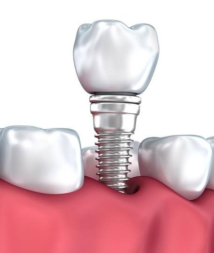 Imagen secundaria 2 - Clínica Dental Reverte