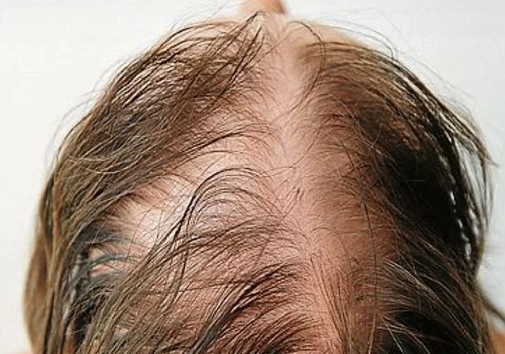 Una persona afectada por alopecia.