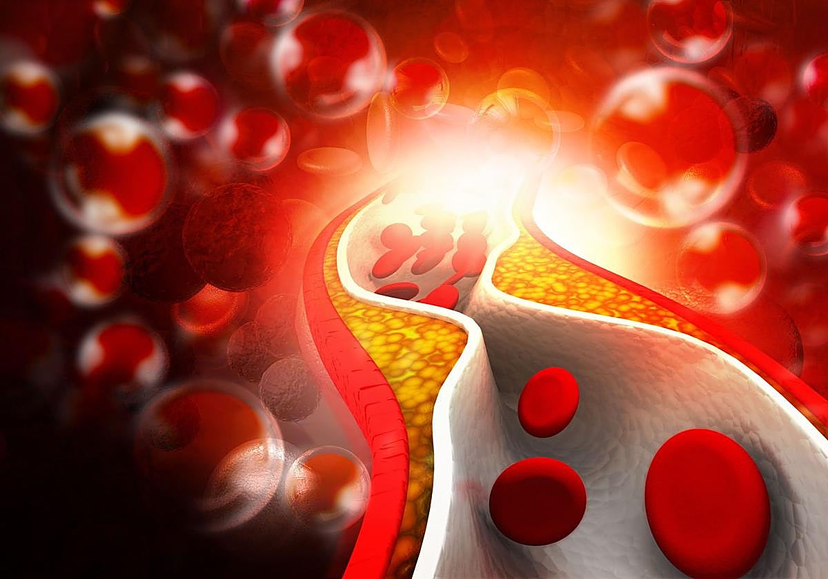 Síntomas de colesterol.