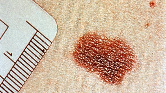 Imagen de un melanoma. 