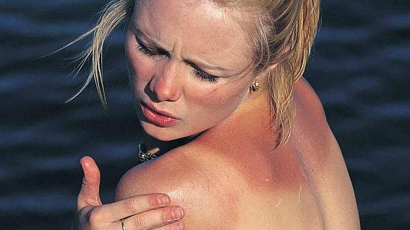 ¿Cómo tratar la piel dañana por el sol?
