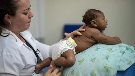 Un bebé con microcefalia a causa del virus del zika en Brasil.