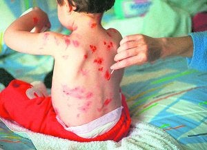 El bloqueo de la venta de la vacuna de la varicela desconcierta a padres y expertos