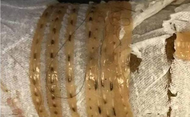 Le extraen un gusano de metro y medio del estómago que tenía por comer sushi