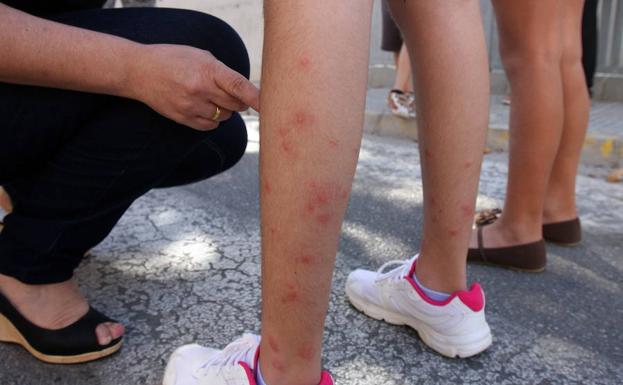 Picaduras de mosquitos en las piernas de una niña.