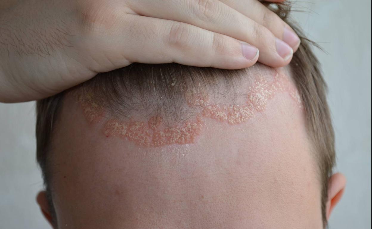 Un hombre afectado por psoriasis en una foto de archivo.