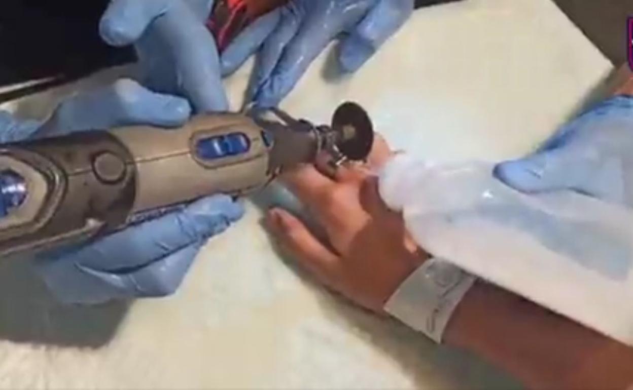 Los bomberos, cortando el anillo que atrapaba el dedo. 