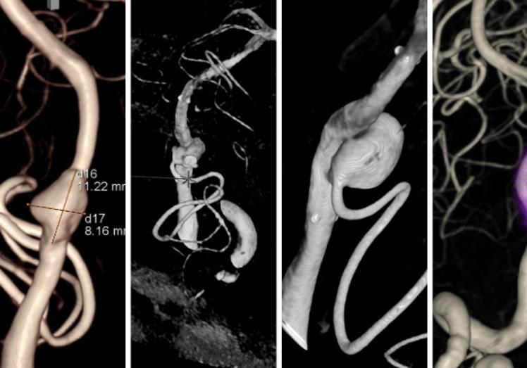 De izquierda a derecha, la evolución del aneurisma que presentaba el paciente. En la primera imagen, el aneurisma, de 1,2 centímetros, al momento del ingreso. Después, la zona tras la colocación del 'stent''. En la tercera imagen se observa como el aneurisma volvió a crecer, lo que obligó a la nueva intervención. En la última imagen, el resultado final, ya sin aneurisma gracias al baipás extracraneal.