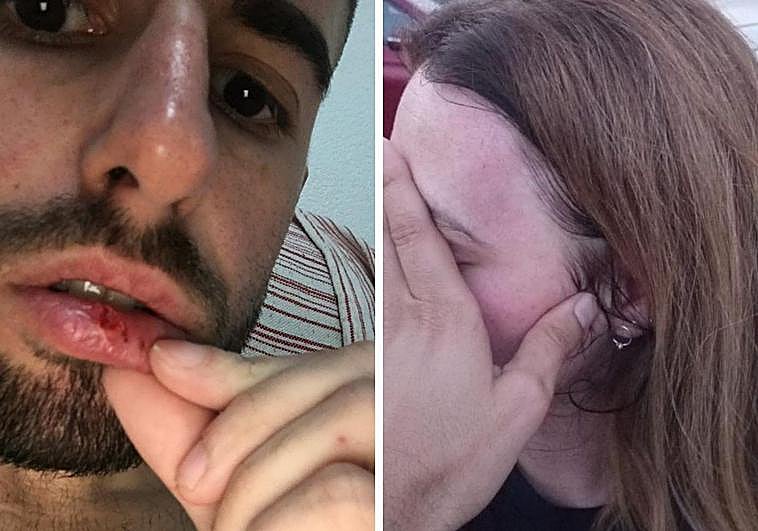 Un jugador del Albudeite y la delegada de campo muestran las heridas recibidas.