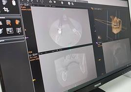 Estudios bucodentales y maxilofaciales en tres dimensiones gracias al nuevo TAC Dental de Quirónsalud Murcia