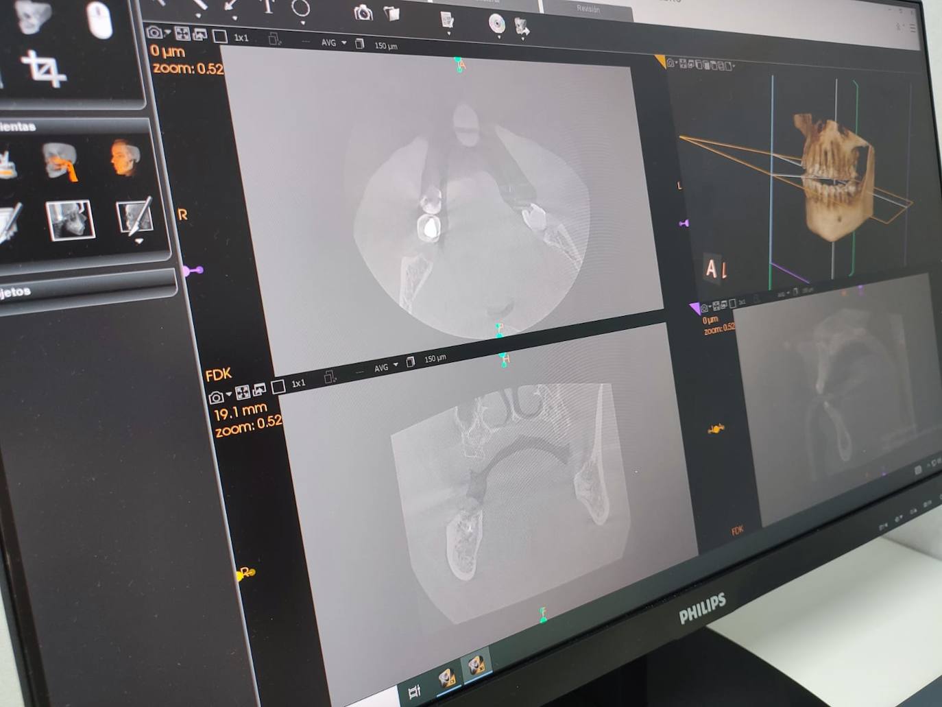 Estudios bucodentales y maxilofaciales en tres dimensiones gracias al nuevo TAC Dental de Quirónsalud Murcia