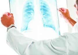 Un médico observa una radiografía de los pulmones.