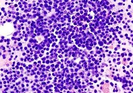 Mieloma múltiple: aspirado de médula ósea; tinción con hematoxilina-eosina.