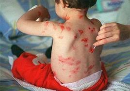 El herpes zóster es una infección que puede desarrollar una persona que ha pasado la varicela.