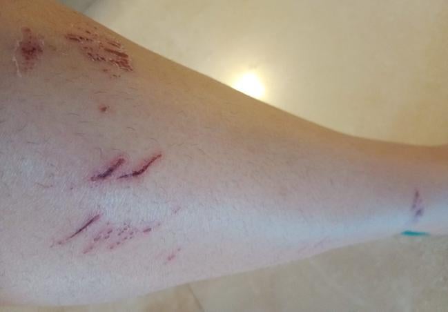 Heridas provocadas en la pierna de una mujer tras caerse en un agujero.