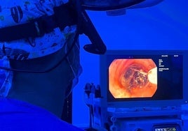El hospital Santa Lucía es el segundo en Europa que emplea las microondas en lesiones centrales de pulmón.