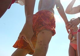 Lesiones causadas por impétigo, ya evolucionadas, en la pierna de un niño.