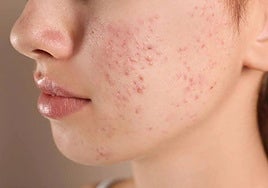 Despídete de los granos: una dermatóloga revela los productos clave para eliminar el acné en casa.