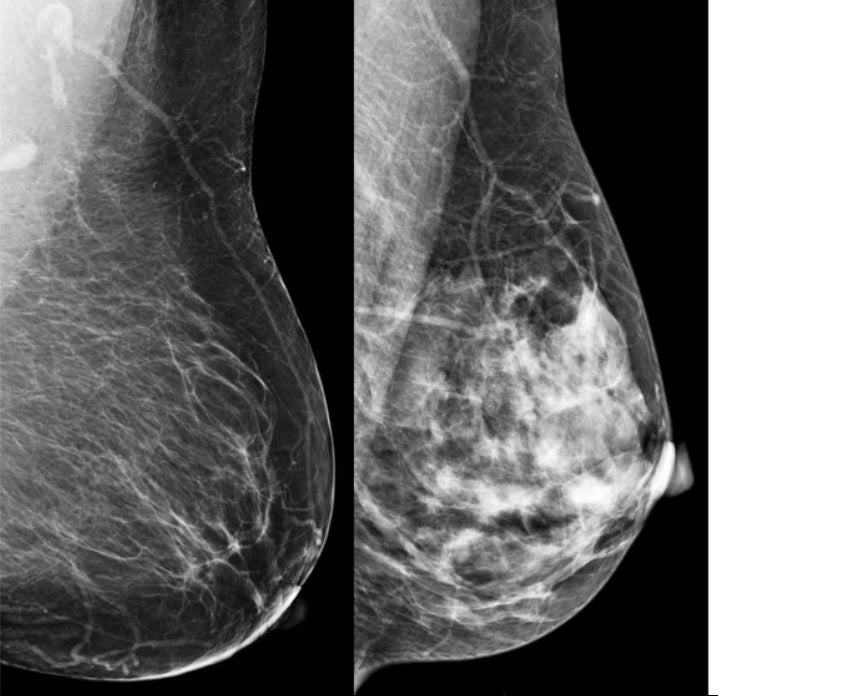 Una mama predominantemente grasa (izquierda) frente a una mama muy densa (derecha). En la mama densa, el tejido glandular aparece blanco igual que un posible tumor, pudiendo ocultarlo y dificultar su detección. En estos casos la ecografía ayuda a ver el tumor que la mamografía podría no diagnosticar.