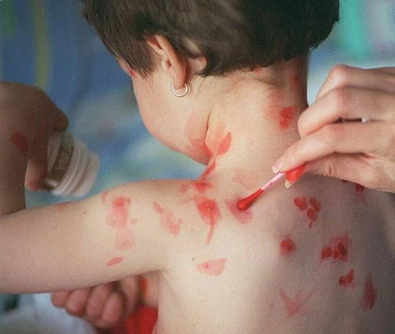 Una niña recibe tratamiento para las pústulas producidas por la enfermedad. 