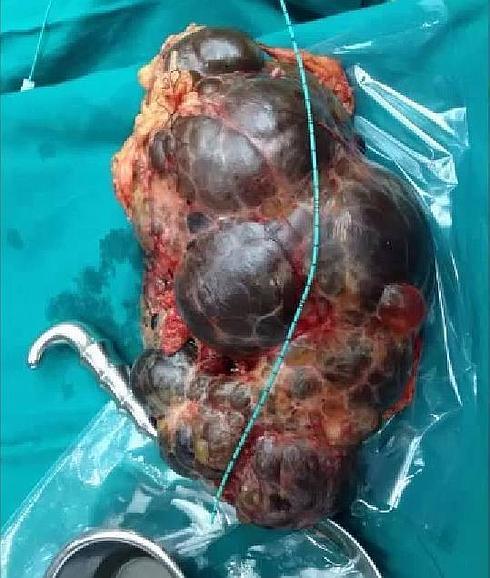 Foto del riñón extraído