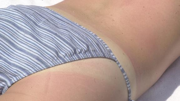 Una joven luce su piel enrojecida por efecto del exceso de exposición al sol.