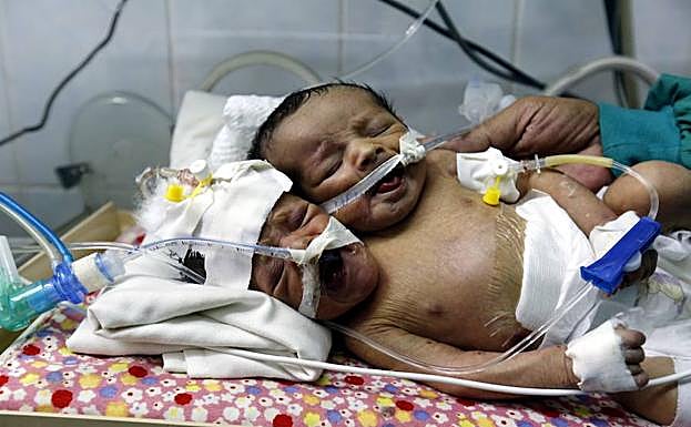 Los hermanos siameses Abdul-Khaliq (dcha) y Abdul-Rahim (izq) descansan en su incubadora.