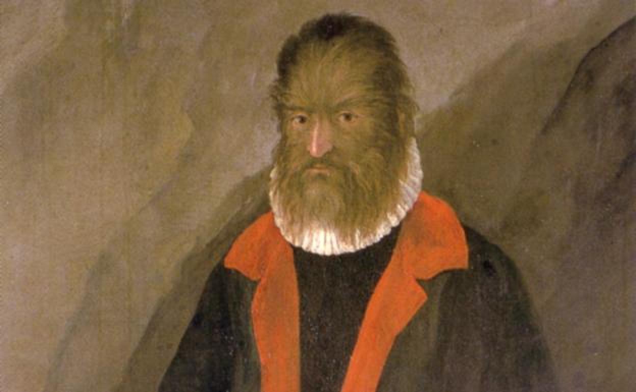 Dibujo de Petrus Gonsalvus, el caso conocico más antiguo de hombre afectado por la enfermedad.