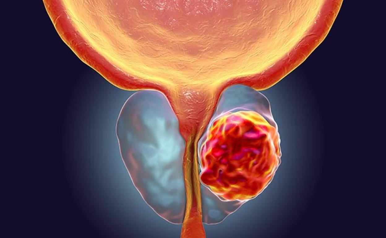 El diagnóstico de cáncer de próstata fue tardío y derivó en el fallecimiento del paciente.