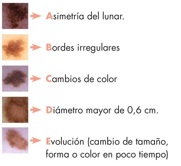 La regla del ABCDE del melanoma.