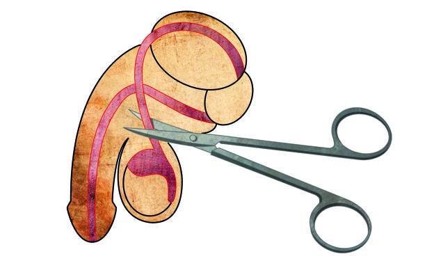 Así se realiza una vasectomía