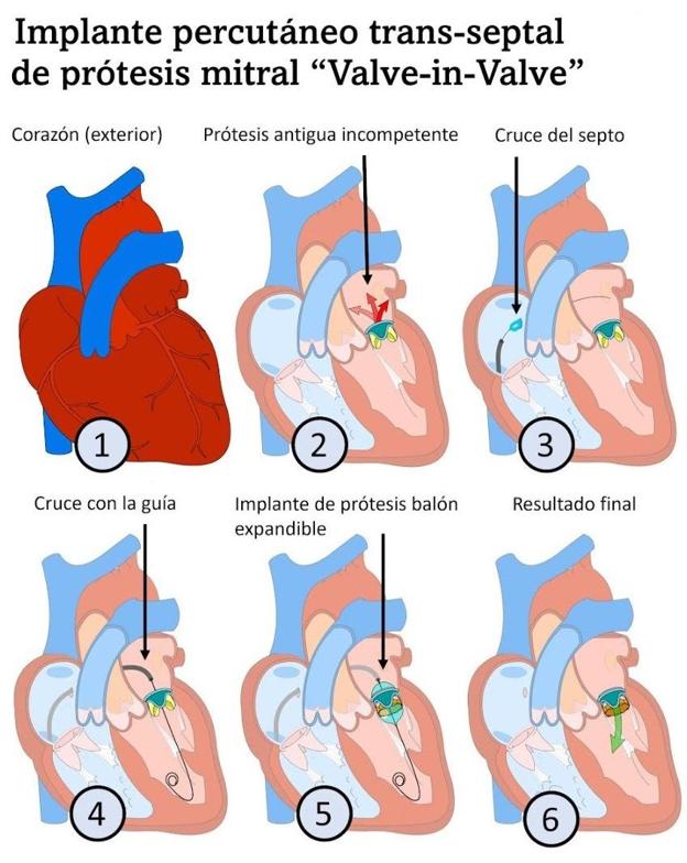 Imagen del proceso realizado durante la operación acometida en el Caule de León. 