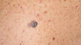 En la provincia de León se detecta un melanoma cada tres días. En lo que va de año, solo en el hospital de León, se han confirmado 41 casos.