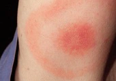 El riesgo de una picadura de garrapata: la enfermedad de Lyme