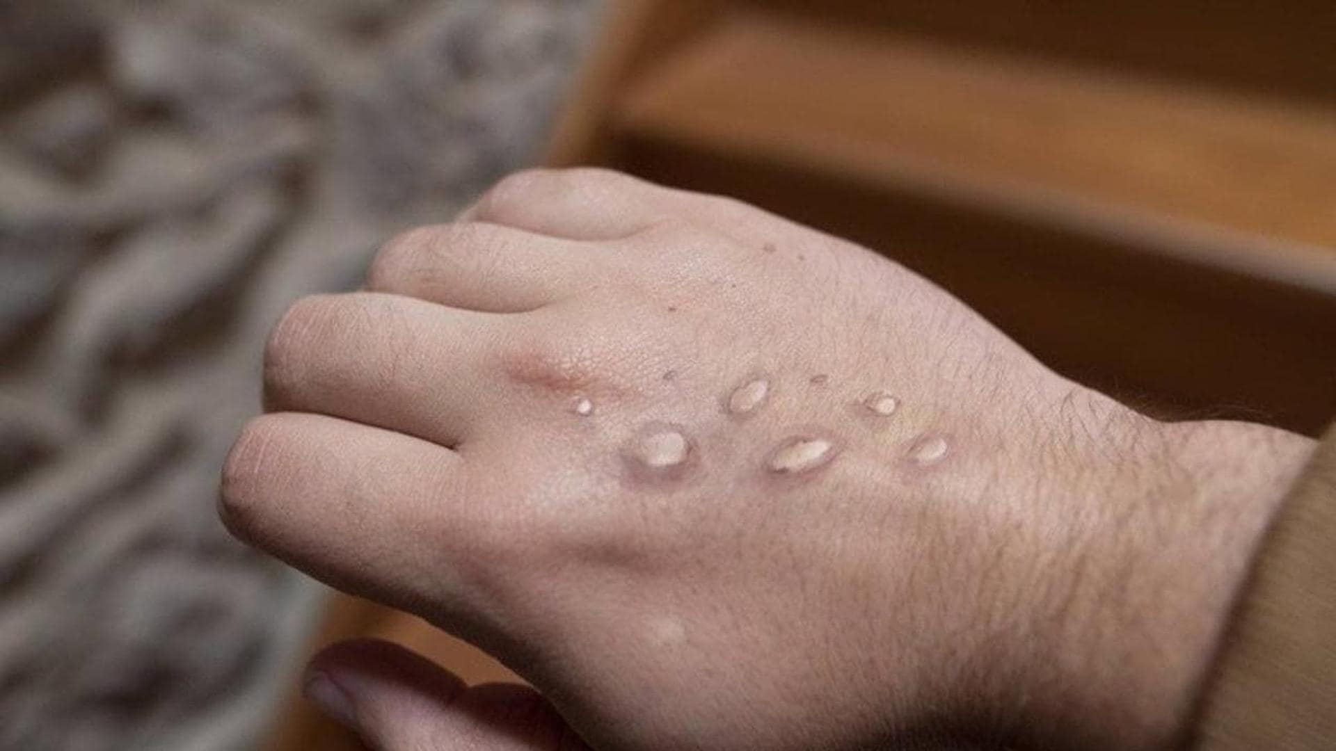 There have been thirteen cases of monkeypox registered in León since 2022, but none this year.