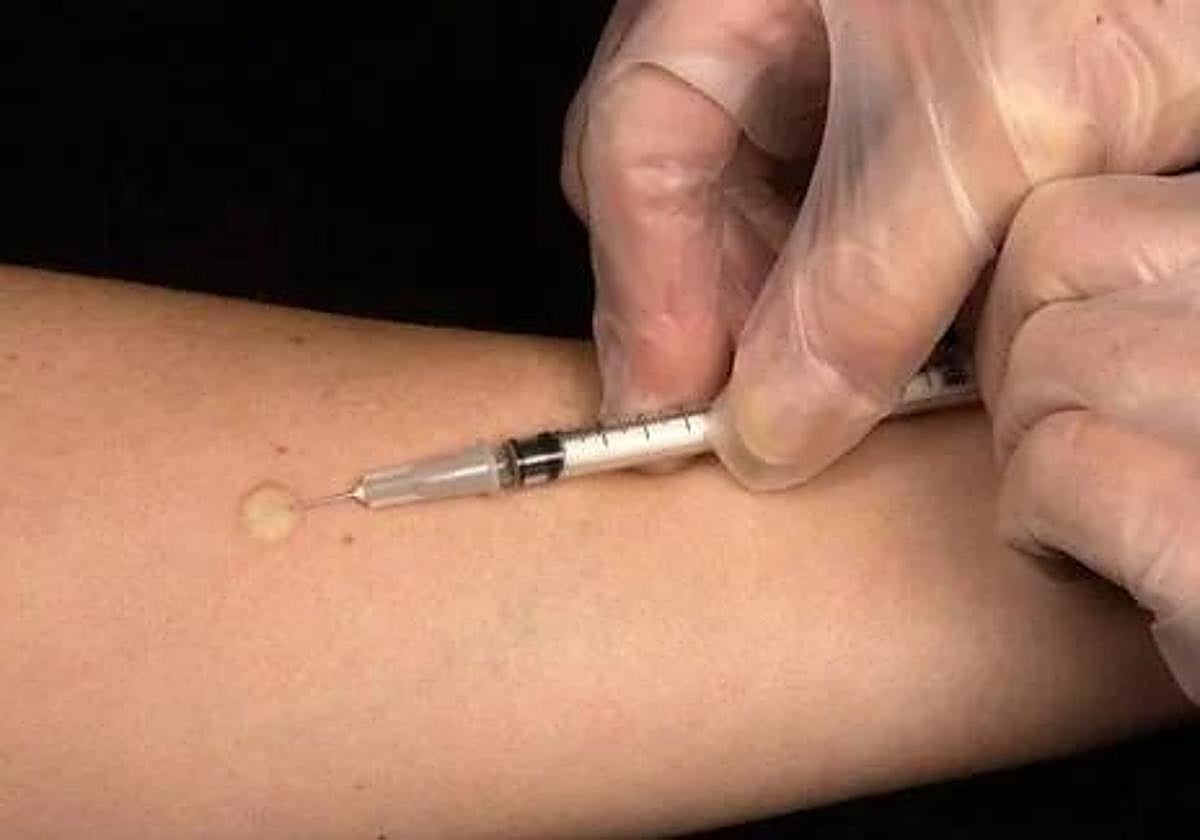 Muestra de tuberculosis en la piel.