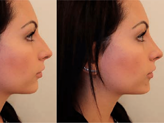 El antes y el después de una rinoplastia ultrasónica realizada por la doctora Pilar de Frutos.