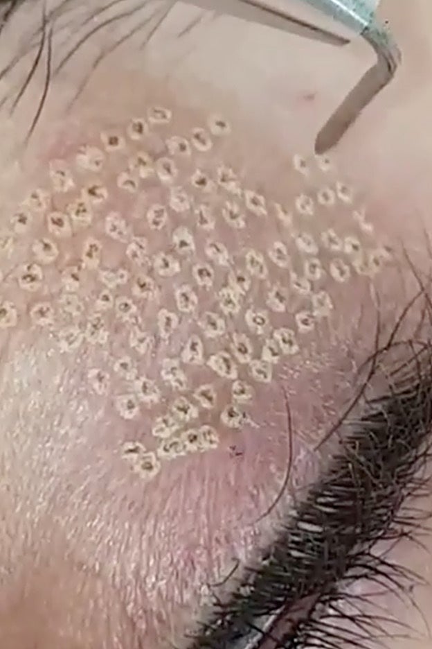 Las microlesiones del láser PLEXR que tensan la piel de los párpados.