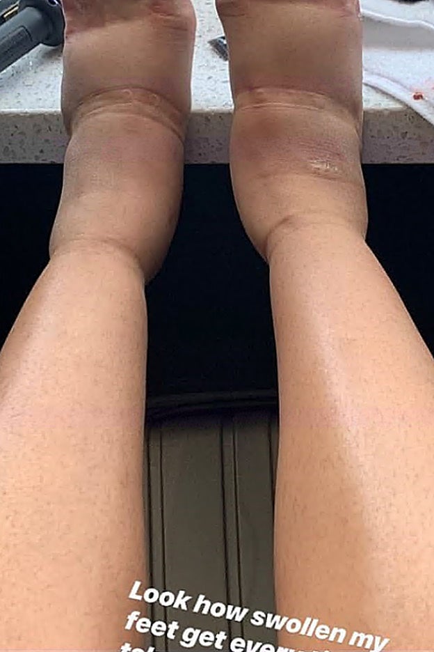 Cardi B publicó en Instagram la foto de sus pies hinchados por la liposucción.