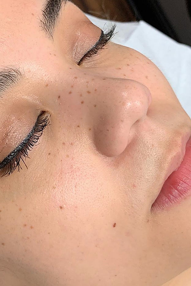 Un ejemplo de micropigmentación para conseguir pecas.