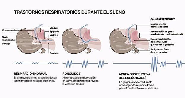 Infografía sobre los trastornos respiratorios durante el sueño.