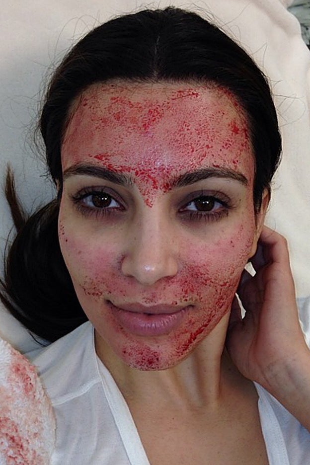El aspecto de la cara de Kim Kardashian en 2013, cuando se hizo el tratamiento vampiro que gracias a ella se viralizó.