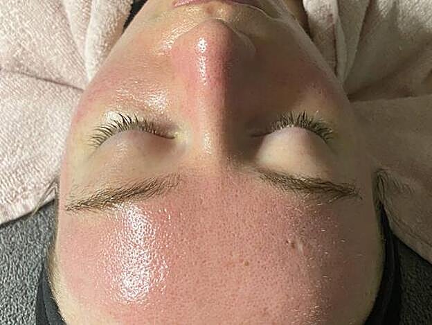 Las rojeces posteriores son habituales... A no ser que duren más de 24 horas.