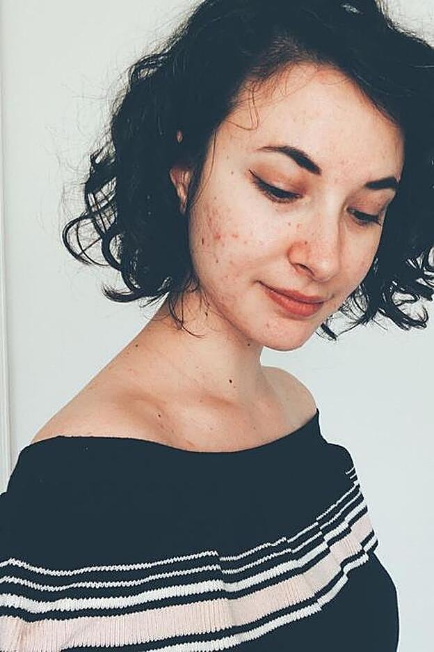 El acné puede ser crónico o pasajero y puede deberse a diversas causas.