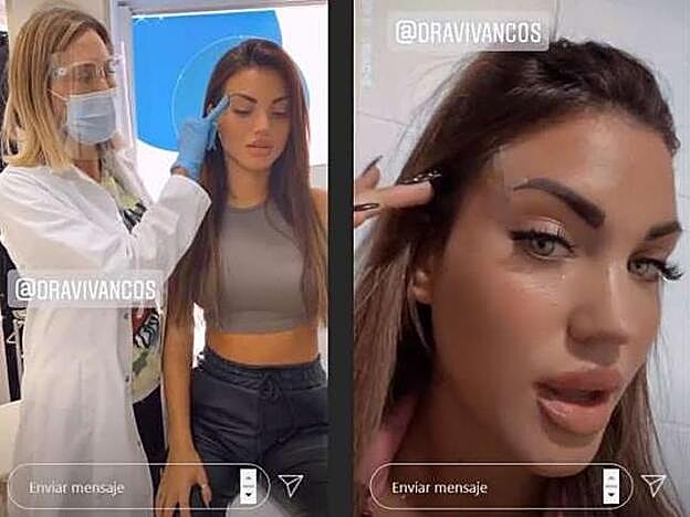 Melodie, la concursante de La isla de las tentaciones, es la última influencer que decide ponerse los hilos tensores para conseguir 'ojos de gata'.